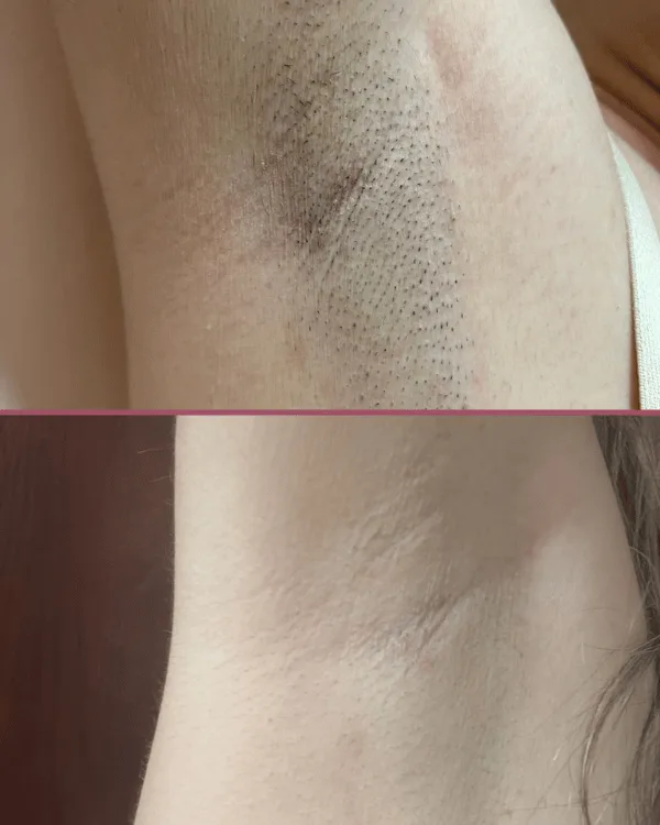 Sessão de depilação a laser na axila na Napelle